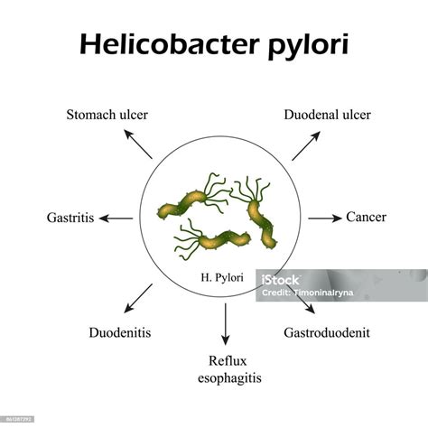 Infographie sur Helicobacter pylori et l'ulcère