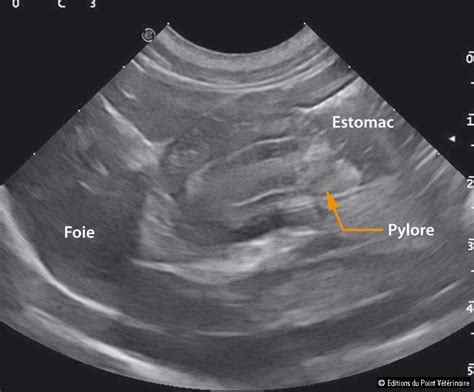 Échographie abdominale montrant une sténose du pylore