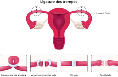 Schéma des différentes directions de ligature