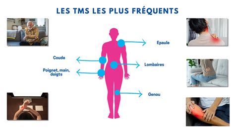 Schéma des douleurs musculo-squelettiques du tondeur