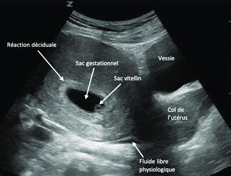 Photo d'une larve de saumon avec sac vitellin visible