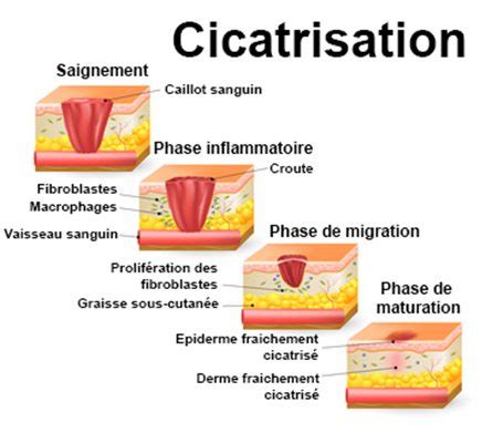 Représentation schématique du processus de cicatrisation
