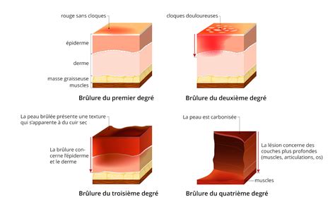 Schéma illustrant la différence visuelle entre une brûlure solaire et une attaque d'oïdium sur une feuille de tomate