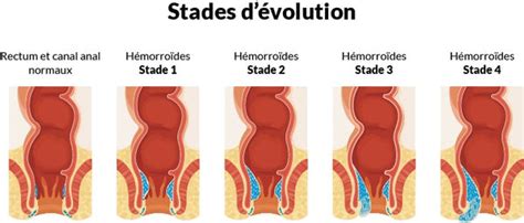 Schéma illustrant les hémorroïdes internes et externes