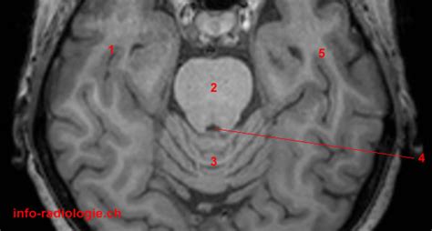 Image illustrant l'importance d'un diagnostic par IRM pour le tronc cérébral