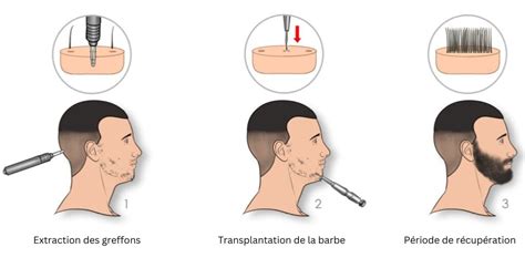 Diagramme illustrant les étapes de la greffe de barbe DHI