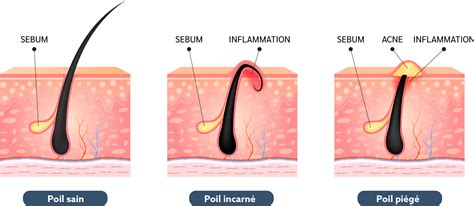 Schéma d'un poil incarné sous la peau