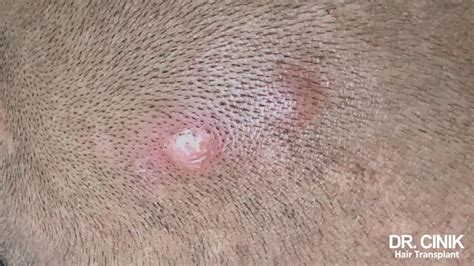 Dermatoscope montrant des signes de folliculite