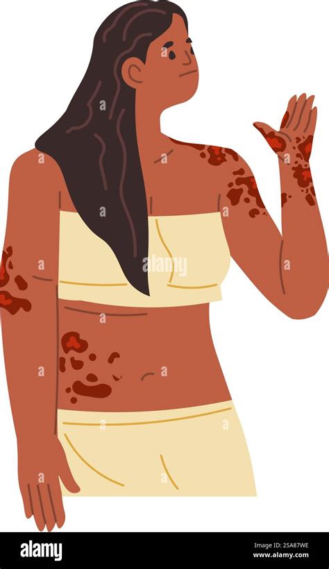 Illustration d'une éruption cutanée sur un bras après un contact avec des végétaux