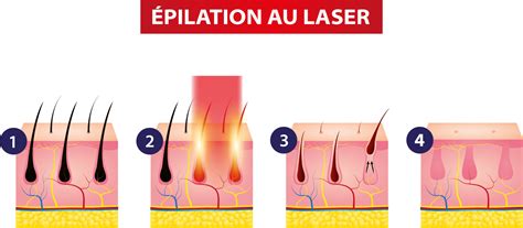 Comparaison visuelle entre une coupe au rasoir et une épilation à la racine