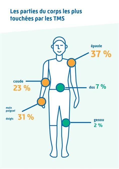 Illustrations des zones affectées par l'hirsutisme