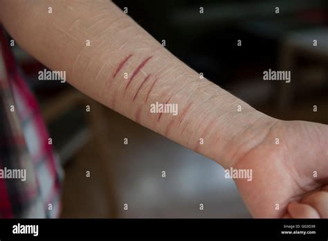 Adolescent avec des cicatrices sur le bras