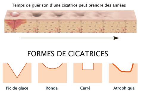 Illustration de cicatrices chéloïdes suite à une scarification