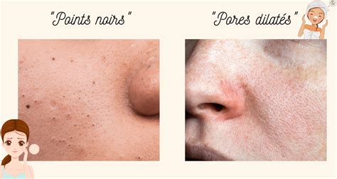 Schéma illustrant l'action des grains exfoliants sur les pores de la peau
