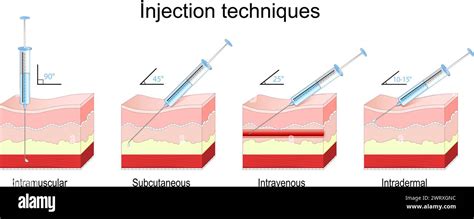 Schéma d'application topique et d'injection de PDRN
