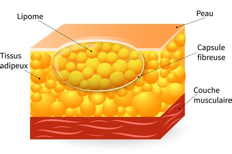 Illustration d'un lipome sous-cutané sur l'abdomen
