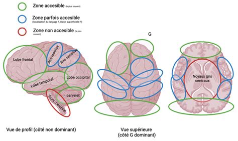 Schéma d'une exérèse chirurgicale de lipome