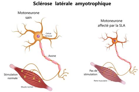 Atteinte du bulbe rachidien par la sclérose latérale amyotrophique