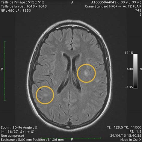 IRM cérébrale pour le diagnostic des lésions du tronc cérébral