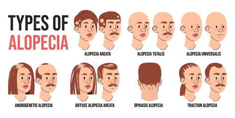 Types d'alopécies