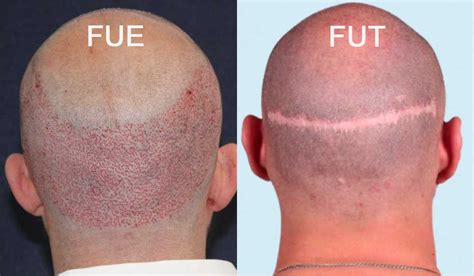 extraction fue cheveux bouclés