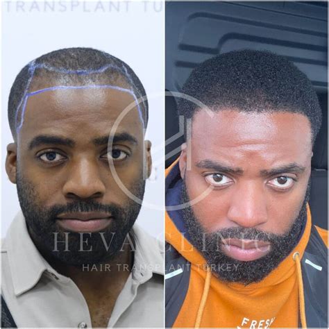 avant après greffe cheveux afro
