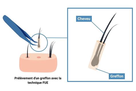 Comparaison entre un follicule intact et un greffon manipulé
