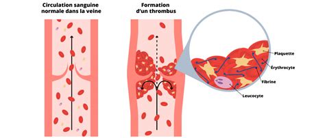 Diagramme des mécanismes de formation d'un thrombus veineux
