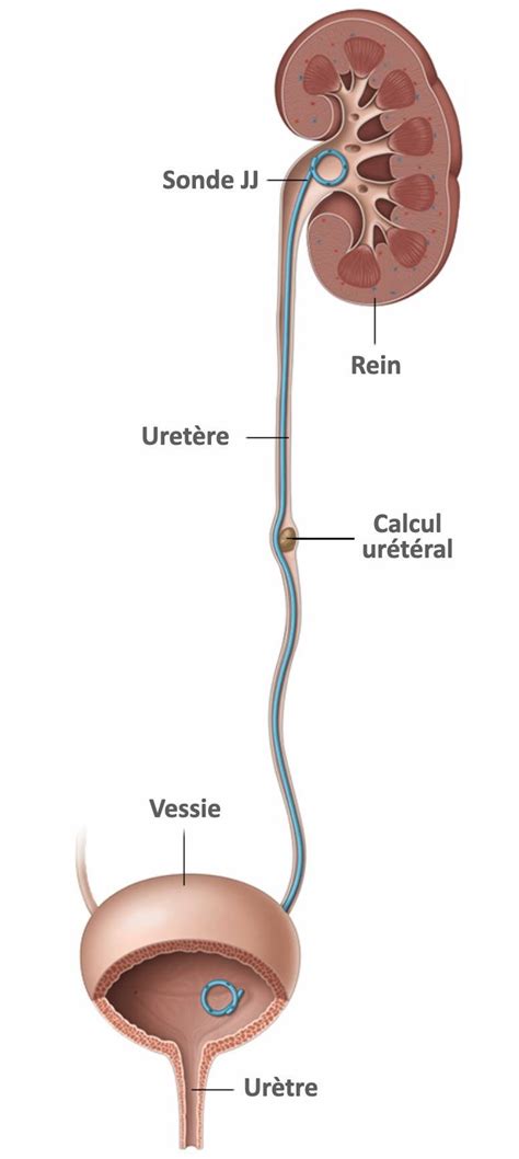 Schéma anatomique illustrant le positionnement d'une sonde double J entre le bassinet rénal et la vessie