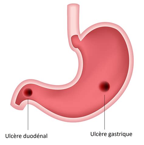 Tableau comparatif des symptômes de l'ulcère gastrique et duodénal