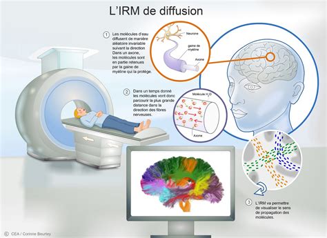 Illustration d'une IRM montrant une collection sous-cutanée
