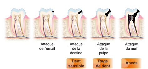 Comparaison visuelle entre une dent standard et une dent renforcée au carbure après usage