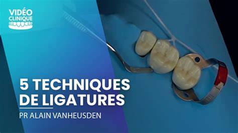 Schéma explicatif des techniques de ligature et de mise en forme