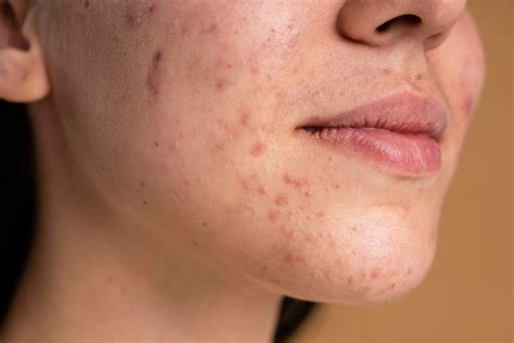 Illustration d'une routine de soins pour peaux acnéiques