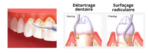 Comparaison entre rempotage et surfaçage