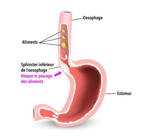 Schéma montrant le fonctionnement du sphincter inférieur de l'œsophage et l'obstruction dans l'achalasie