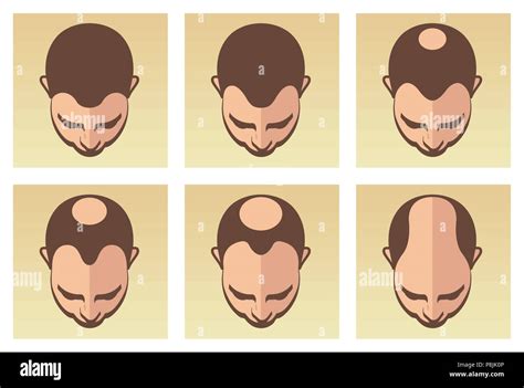 Illustration montrant différentes causes de perte de cheveux