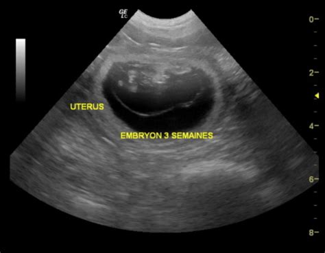 Échographie de gestation